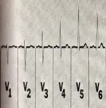 Ecg nº 39 para principiantes