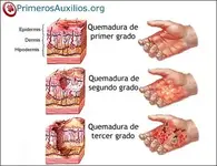 Quemaduras en desfibrilación