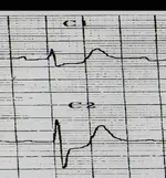 Ecg nº 39 para principiantes