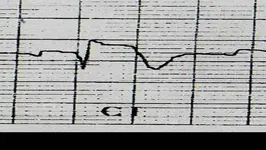 Ecg nº 39 para principiantes