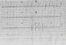 Ecg nº 39 para principiantes