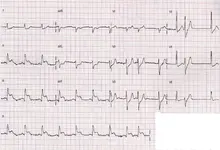 Ecg nº 40 para principiantes