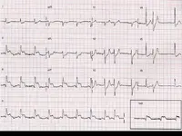 Ecg nº 40 para principiantes