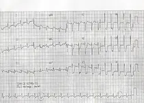 Ecg nº 41 para principiantes