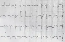 Ecg nº 42 para principiantes