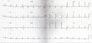 Ecg nº 43  para principiantes