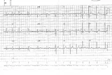 Ecg nº 44 para principiantes