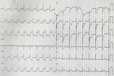 Ecg nº 45 para principiantes