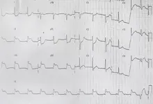 Ecg nº 45 para principiantes