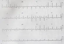 Ecg nº 45 para principiantes