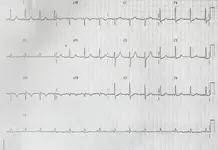 Ecg nº 45 para principiantes