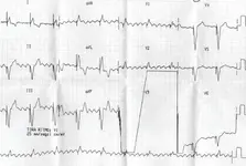 Ecg nº 46 para principiantes