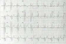 Ecg nº 47 para principiantes