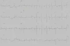 Ecg nº 49 para principiantes