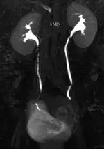 Infeccion Vias Urinarias Recurrentes