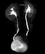 Infeccion Vias Urinarias Recurrentes