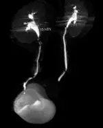 Infeccion Vias Urinarias Recurrentes