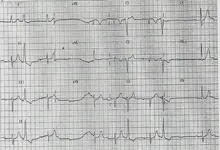 ECG nº 50 para principiantes