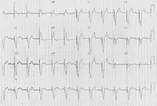 ECG nº 51 para principiantes