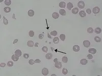 Brote del síndrome urémico hemolítico