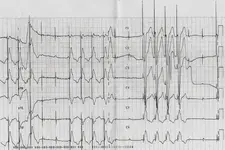 ECG nº 52 para principiantes