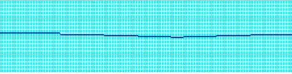 ECG nº 53 para principiantes