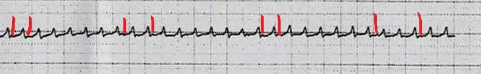 ECG nº 53 para principiantes