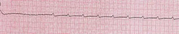 ECG nº 53 para principiantes
