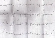 ECG  nº 54  para  principiantes