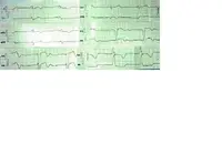 Paciente con dolor torácico y disnea. Paciente con dolor torácico y disnea.