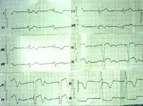 Paciente con dolor torácico y disnea.