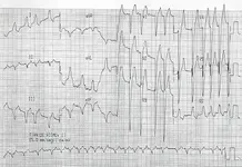 ECG nº 55 para principiantes
