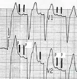 ECG nº 55 para principiantes