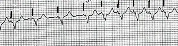 ECG nº 55 para principiantes