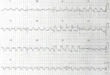 ECG nº 56 para principiantes