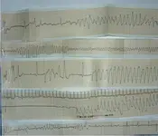 Paciente con dolor torácico y disnea.