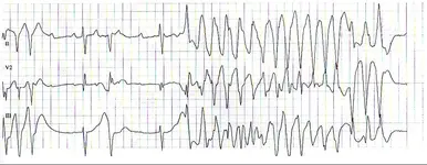 ECG nº 57 para principiantes
