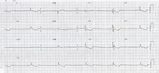 ECG nº 57 para principiantes