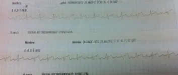 Necesito ayuda con un electrocardiograma