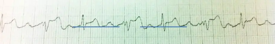 Necesito ayuda con un electrocardiograma
