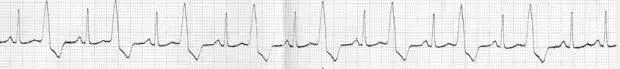 Necesito ayuda con un electrocardiograma