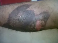 Quemadura tratada con medios naturales.
