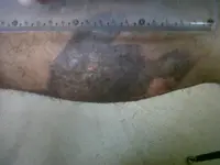 Quemadura tratada con medios naturales.