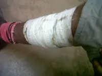 Quemadura tratada con medios naturales.