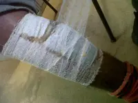 Quemadura tratada con medios naturales.