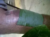 Quemadura tratada con medios naturales.