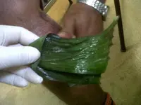 Quemadura tratada con medios naturales.