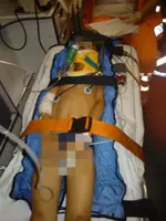 Inmovilización pediátrica