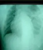 Traumatismo directo abdominal