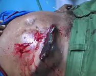 Trauma penetrante de abdomen